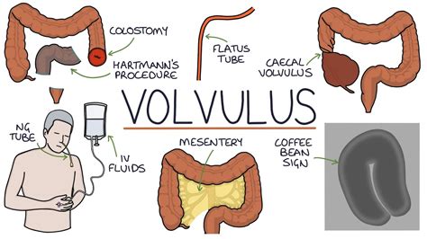 diagram of cecal volvulus 